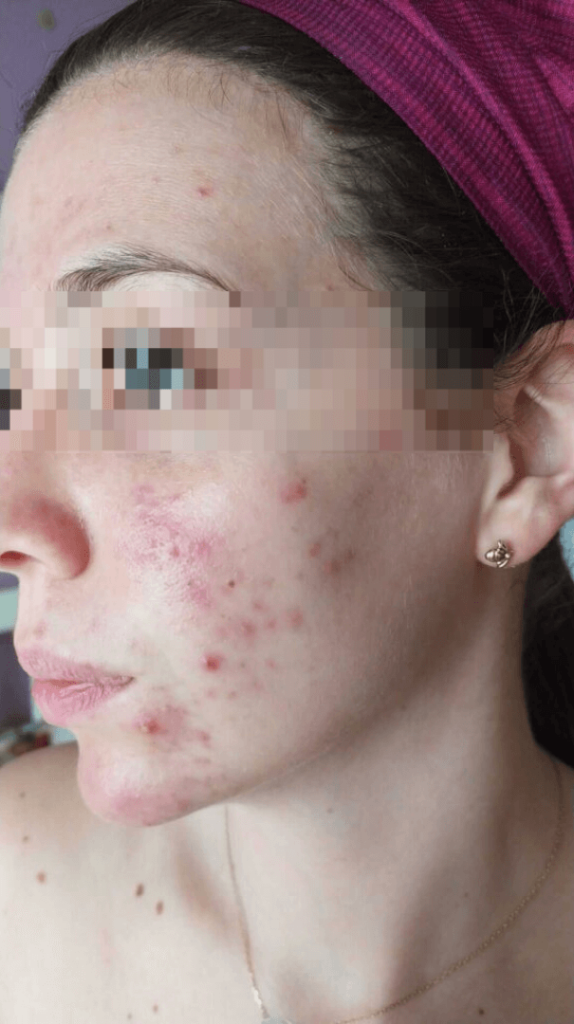 acne-giovanile-I-fase-trattamento-protocollo-Neoglis2