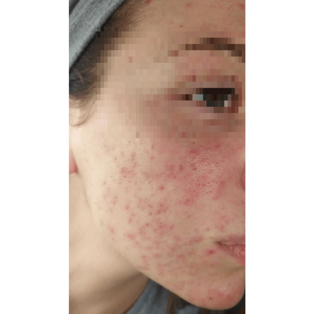 combattere-l-acne-con-prodotti-neoglis-i-risultati-II-fase-trattamento