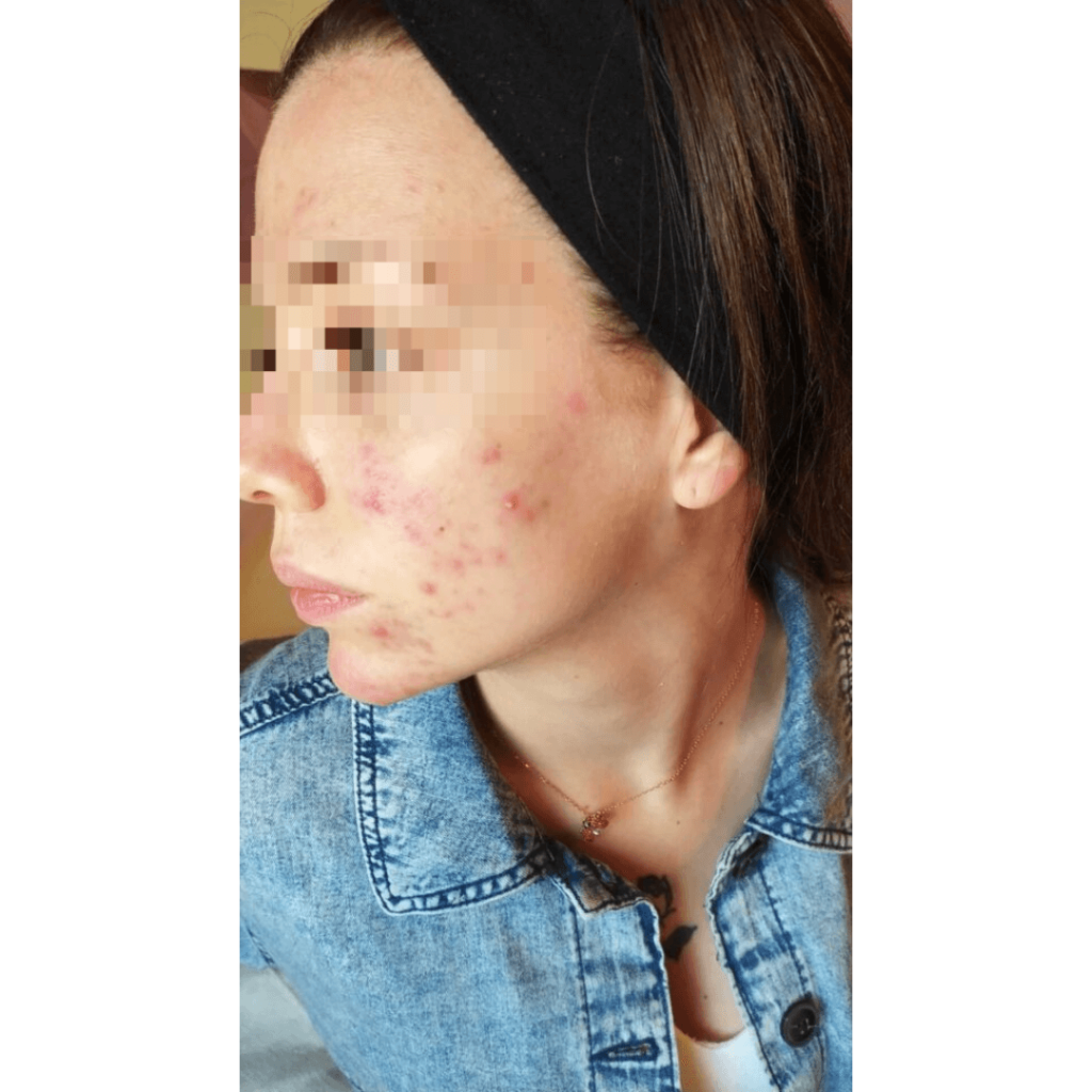 come-curare-acne-con-prodotti-neoglis-i-risultati-II-fase-trattamento