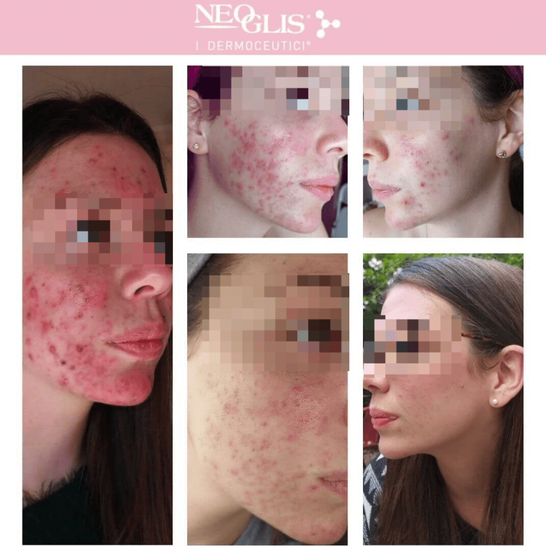 trattamento-acne-neoglis