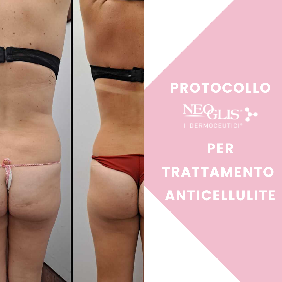 trattamento-anticellulite-con-prodotti-neoglis