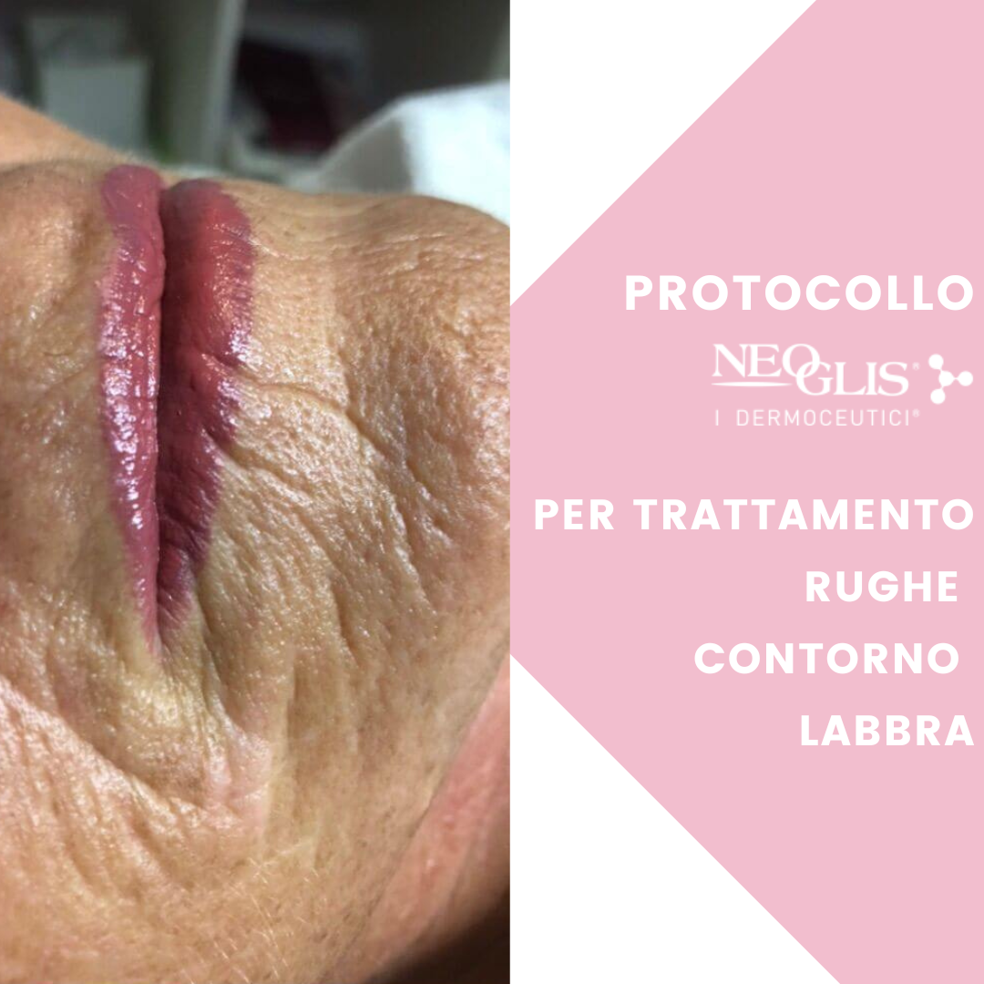 RUGHE-CONTORNO-LABBRA-COME-ELIMINARLE-NEOGLIS